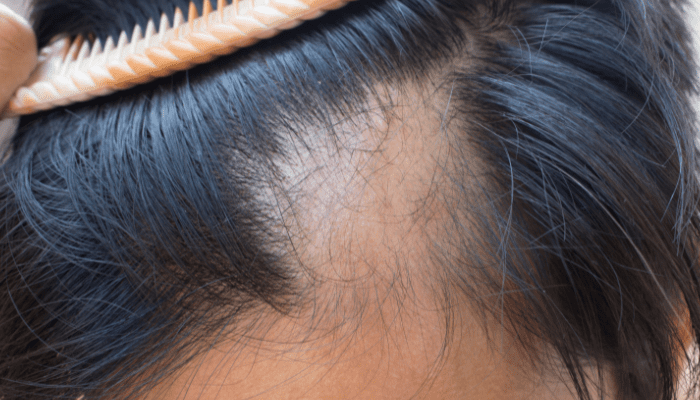 Hormones, Hair Growth and Hair Loss