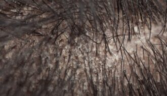 Is Seborrheic Dermatitis Hair Loss Permanent