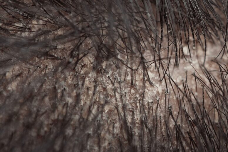 Is Seborrheic Dermatitis Hair Loss Permanent