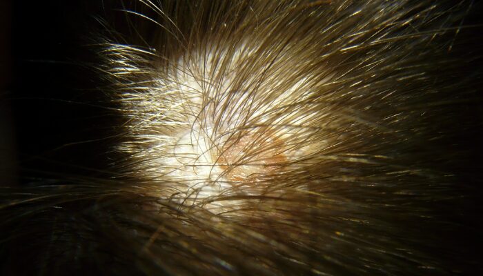 is seborrheic dermatitis hair loss permanent